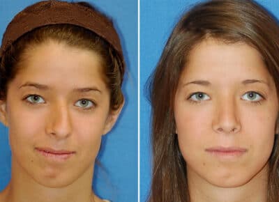 Rhinoplasty Patient – 2