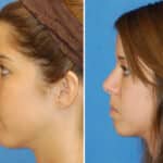Thumbnail of http://rhinoplasty%20patient%20before%20and%20after