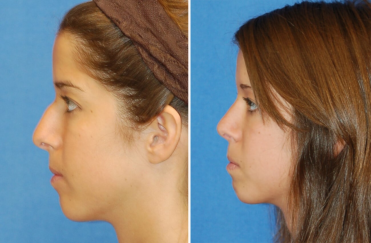 rhinoplasty patient before and after