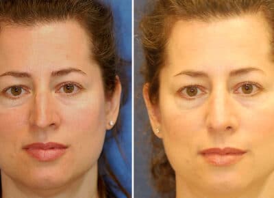 Rhinoplasty Patient – 3