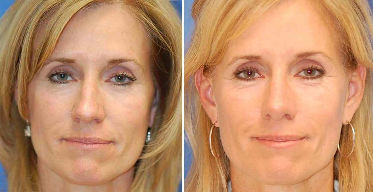 rhinoplasty patient before and after
