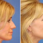 Thumbnail of http://rhinoplasty%20patient%20before%20and%20after