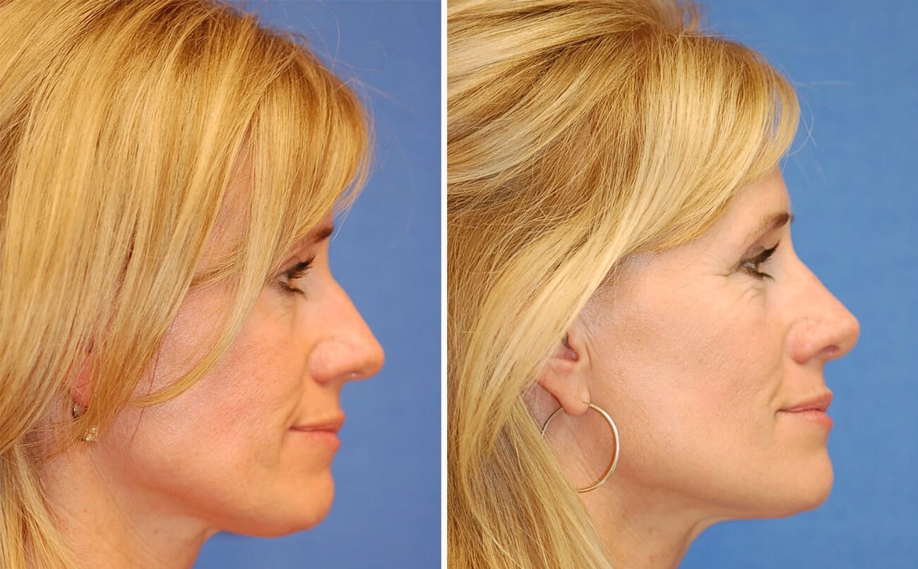 rhinoplasty patient before and after