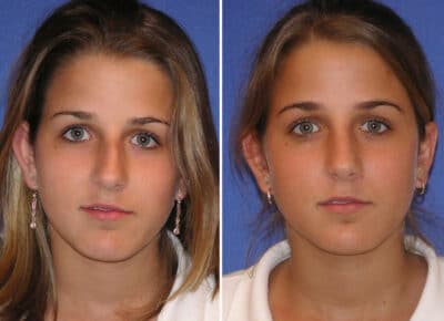 Rhinoplasty Patient – 7