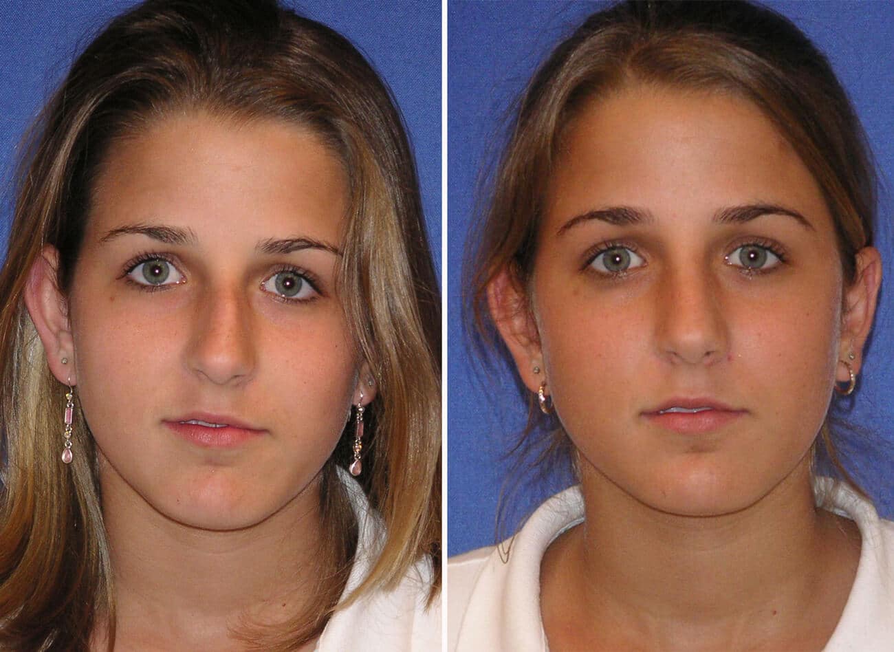rhinoplasty patient before and after
