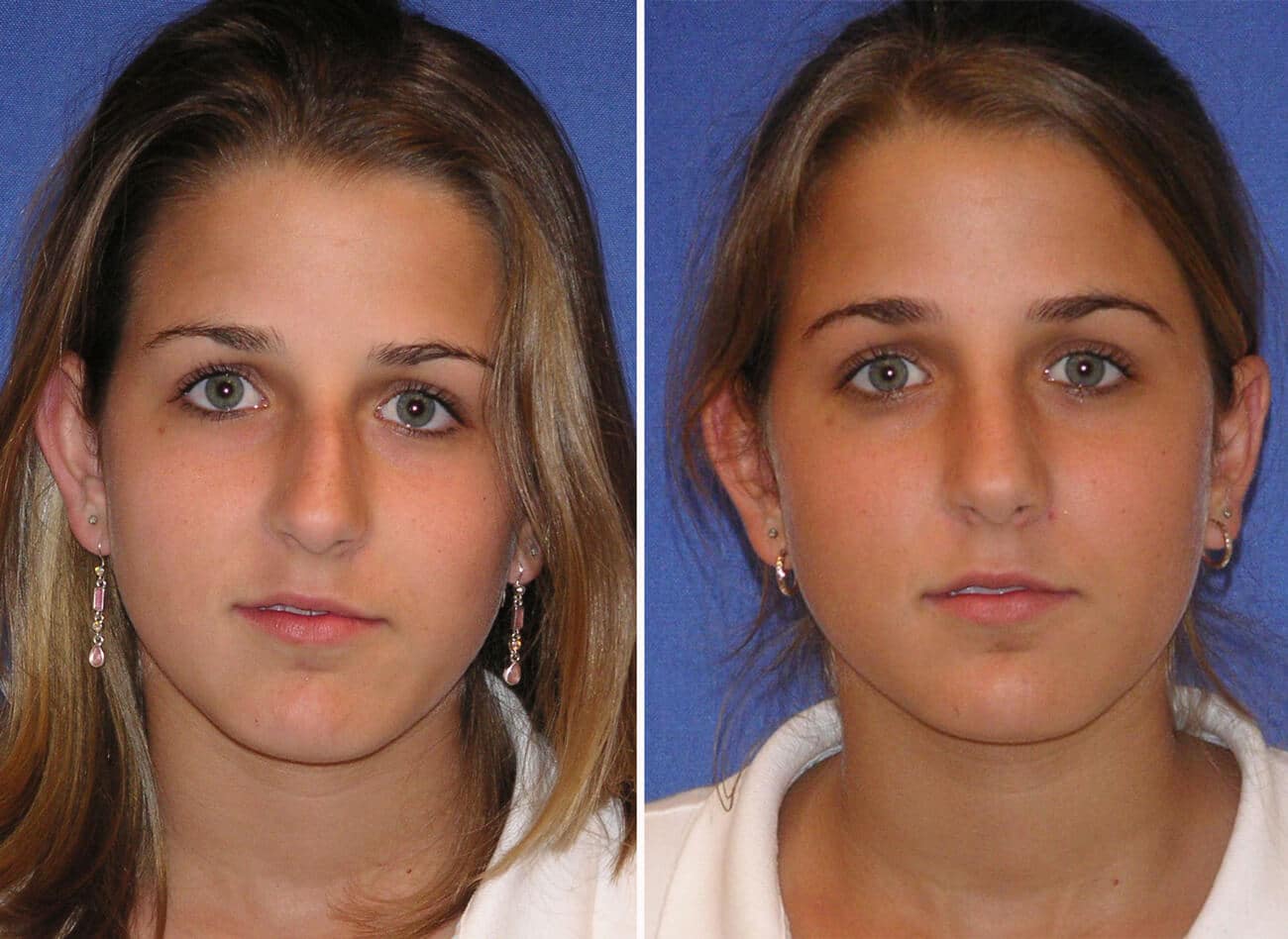 rhinoplasty patient before and after