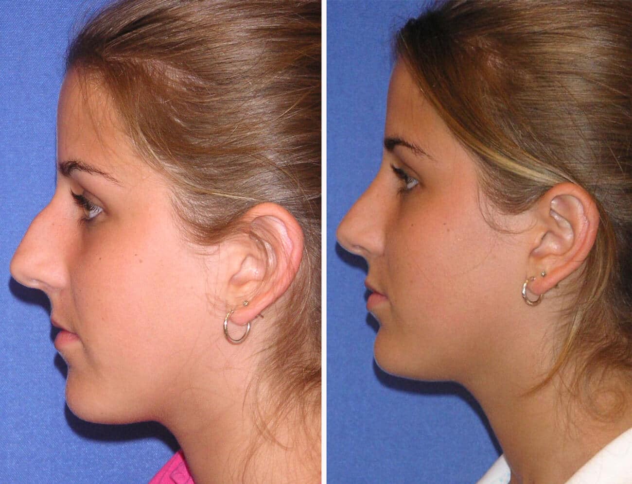 rhinoplasty patient before and after