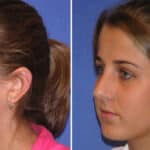 Thumbnail of http://rhinoplasty%20patient%20before%20and%20after