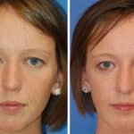 Thumbnail of http://rhinoplasty%20patient%20before%20and%20after