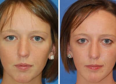 Rhinoplasty Patient – 6