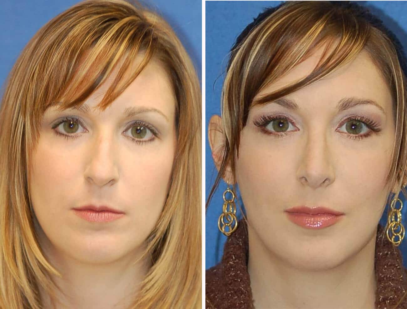 rhinoplasty patient before and after