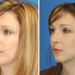 Thumbnail of http://rhinoplasty%20patient%20before%20and%20after