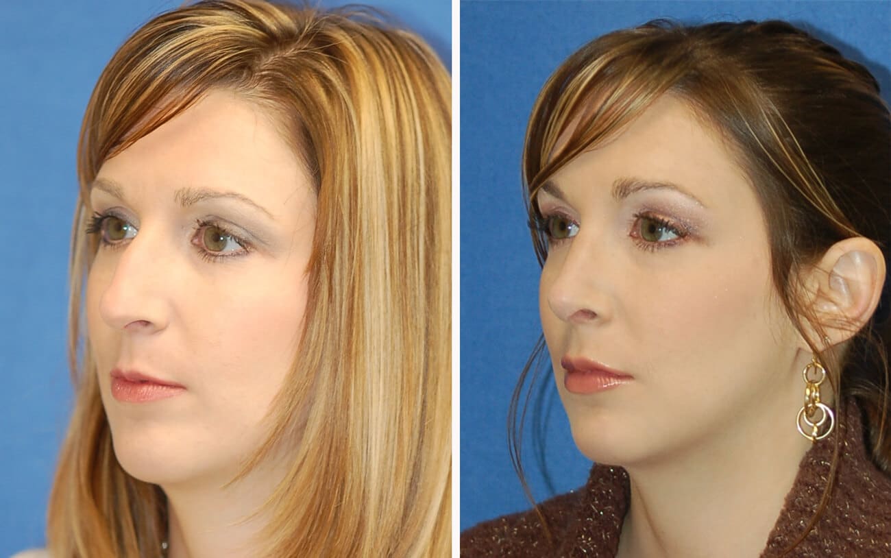 rhinoplasty patient before and after