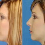 Thumbnail of http://rhinoplasty%20patient%20before%20and%20after