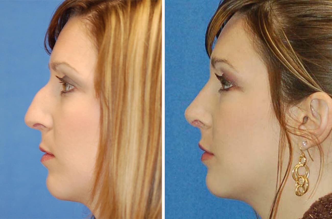 rhinoplasty patient before and after
