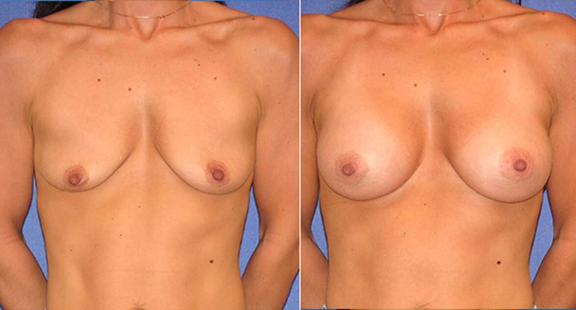 snyder before and after breast augmentation procedure