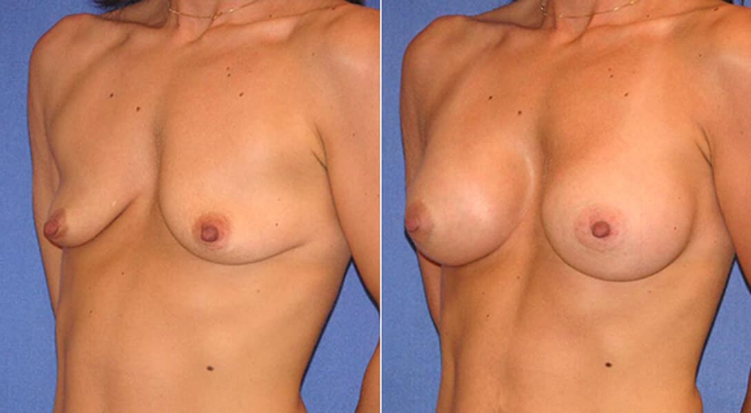 snyder before and after breast augmentation procedure