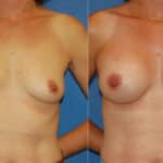 Thumbnail of http://snyder%20before%20and%20after%20breast%20augmentation%20procedure