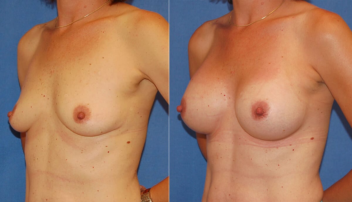snyder before and after breast augmentation procedure