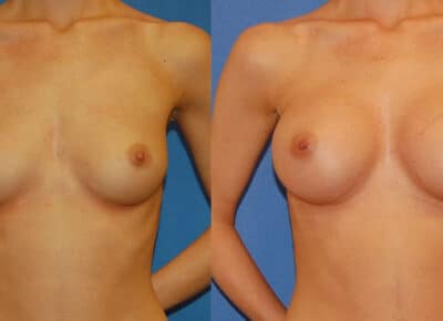 Breast Augmentation Patient – 13