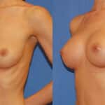 Thumbnail of http://snyder%20before%20and%20after%20breast%20augmentation%20procedure