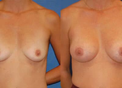 Breast Augmentation Patient – 14