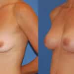 Thumbnail of http://snyder%20before%20and%20after%20breast%20augmentation%20procedure