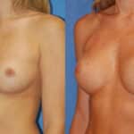 Thumbnail of http://snyder%20before%20and%20after%20breast%20augmentation%20procedure