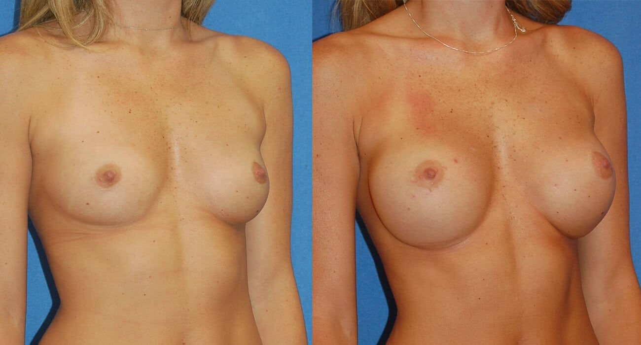 snyder before and after breast augmentation procedure