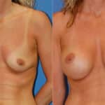 Thumbnail of http://snyder%20before%20and%20after%20breast%20augmentation%20procedure