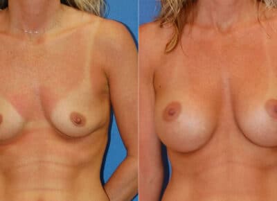 Breast Augmentation Patient – 2