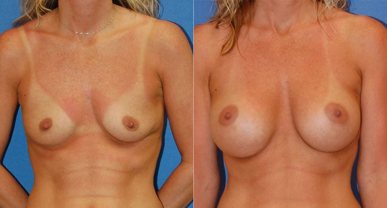 snyder before and after breast augmentation procedure