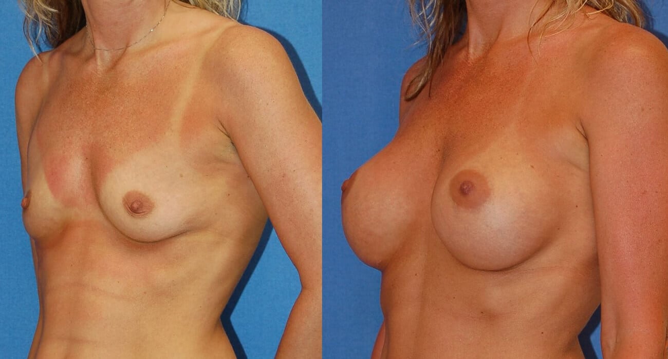 snyder before and after breast augmentation procedure