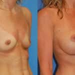 Thumbnail of http://snyder%20before%20and%20after%20breast%20augmentation%20procedure