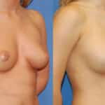 Thumbnail of http://snyder%20before%20and%20after%20breast%20augmentation%20procedure