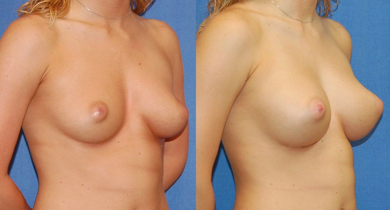 snyder before and after breast augmentation procedure