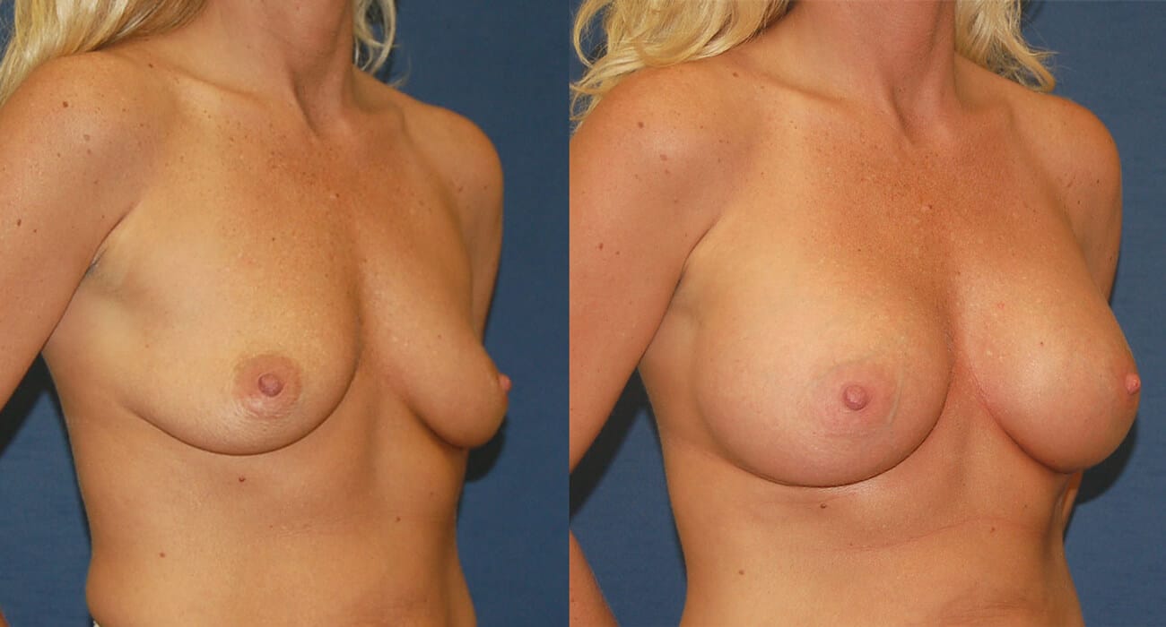 snyder before and after breast augmentation procedure
