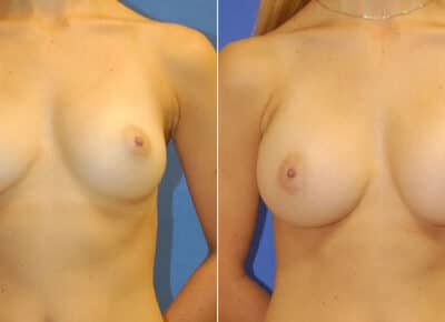 Breast Augmentation Patient – 4