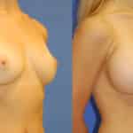 Thumbnail of http://snyder%20before%20and%20after%20breast%20augmentation%20procedure