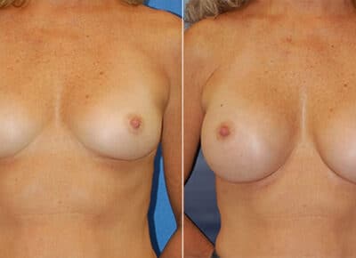 Breast Augmentation Patient – 5