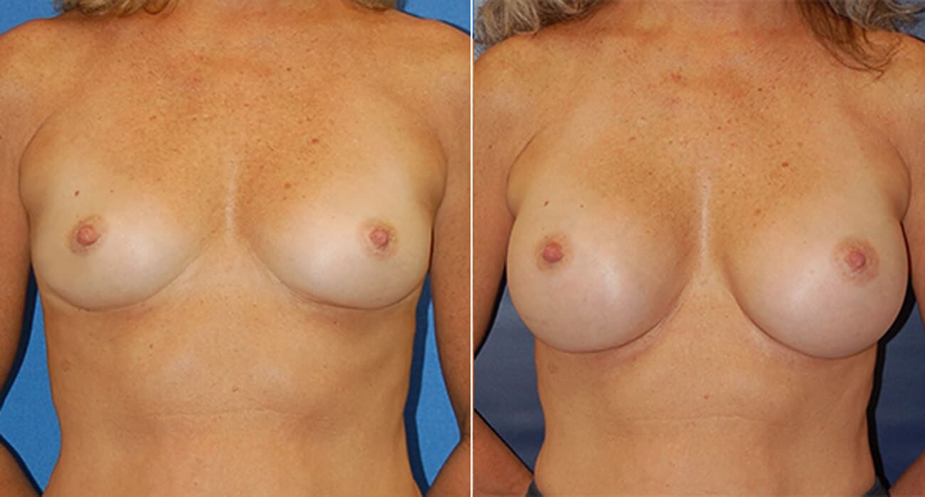 snyder before and after breast augmentation procedure