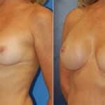 Thumbnail of http://snyder%20before%20and%20after%20breast%20augmentation%20procedure