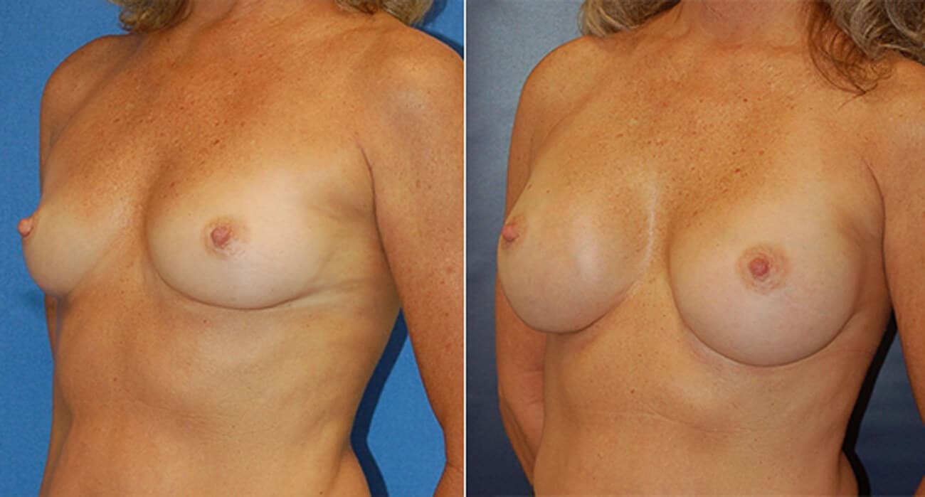 snyder before and after breast augmentation procedure