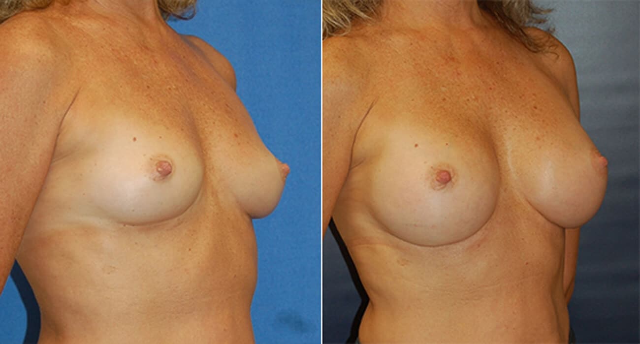 snyder before and after breast augmentation procedure