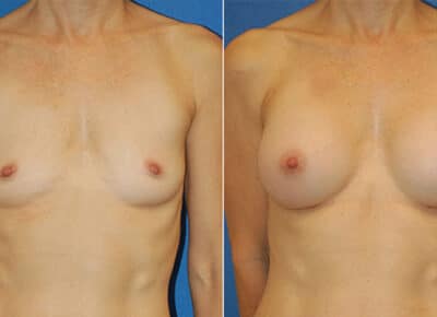 Breast Augmentation Patient- 10