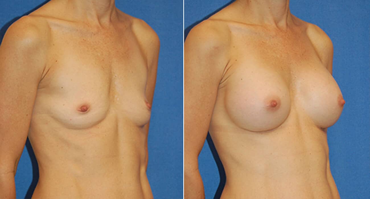 snyder before and after breast augmentation procedure