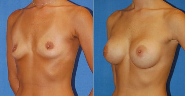 snyder before and after breast augmentation procedure