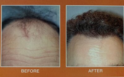Hair Restoration for Men