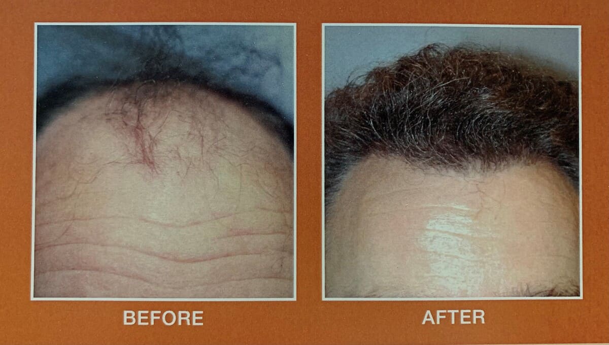 6-21-hair-restoration compressed