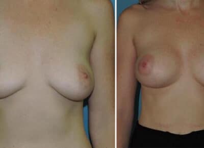 Breast Augmentation Patient – 6